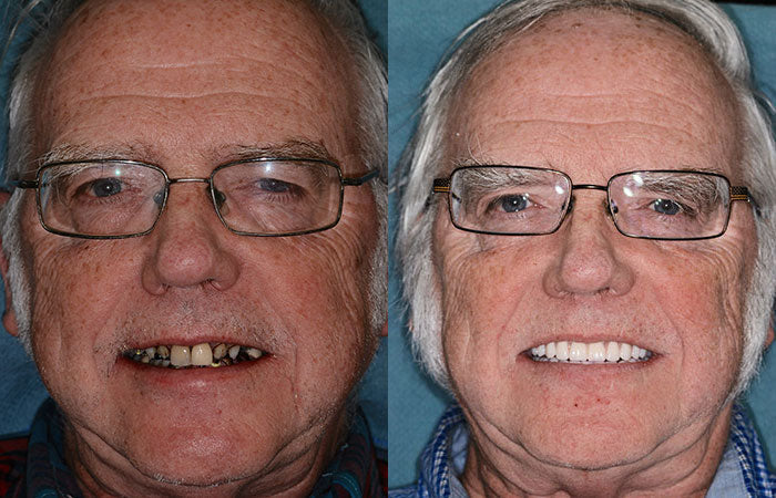 🇩🇪 Vaxflite™ – Germany Custom-Crafted Dentures for a Seamless, High-End Smile