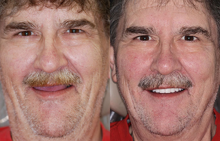 🇩🇪 Vaxflite™ – Germany Custom-Crafted Dentures for a Seamless, High-End Smile