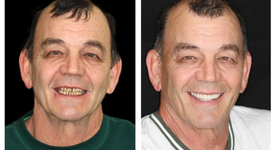 🇩🇪 Vaxflite™ – Germany Custom-Crafted Dentures for a Seamless, High-End Smile