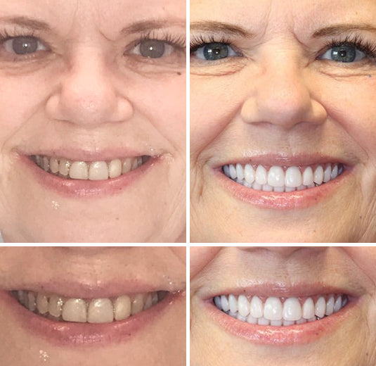 🇩🇪 Vaxflite™ – Germany Custom-Crafted Dentures for a Seamless, High-End Smile