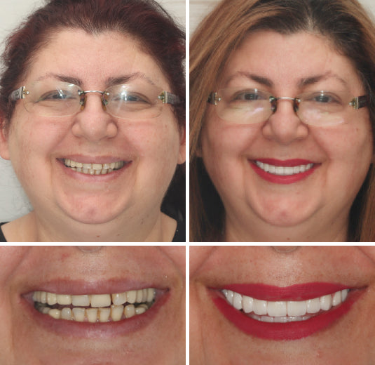 🇩🇪 Vaxflite™ – Germany Custom-Crafted Dentures for a Seamless, High-End Smile