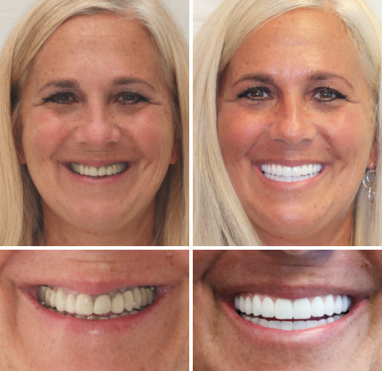 🇩🇪 Vaxflite™ – Germany Custom-Crafted Dentures for a Seamless, High-End Smile