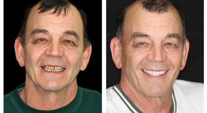 🇩🇪 Vaxflite™ – Germany Custom-Crafted Dentures for a Seamless, High-End Smile