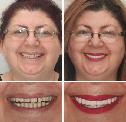 🇩🇪 Vaxflite™ – Germany Custom-Crafted Dentures for a Seamless, High-End Smile