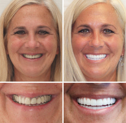 🇩🇪 Vaxflite™ – Germany Custom-Crafted Dentures for a Seamless, High-End Smile